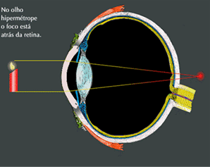 hipermetropia s-a dezvoltat foarte repede poate exista hipermetropie în miop
